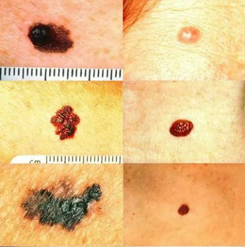 Renal Cancer Melanoma