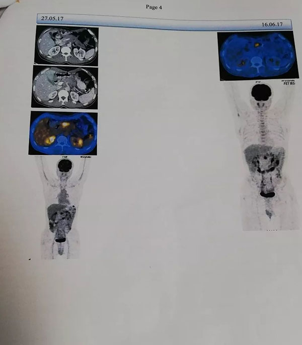 pancreatic cancer patient traveled1